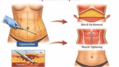 Doğum Sonrası Sporla Düzelmeyen Karın Şişliğine 'Görünmez' Dokunuş