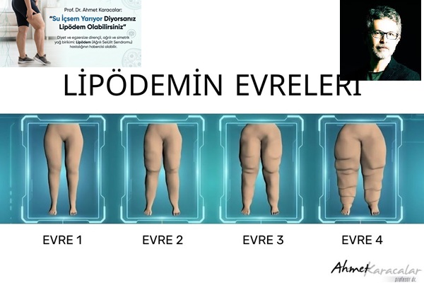 Karacalar, Su İçsem Yarıyor Diyorsanız Lipödem Olabilirsiniz