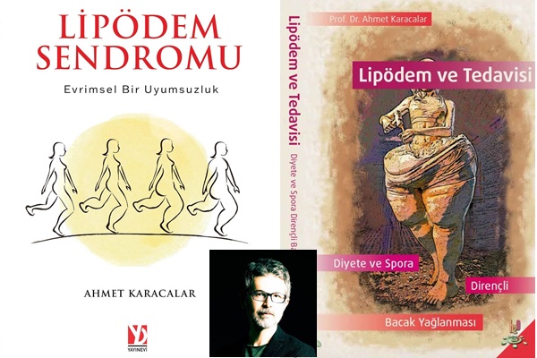 Kilo Veremiyorsanız Lipödem Olabilirsiniz